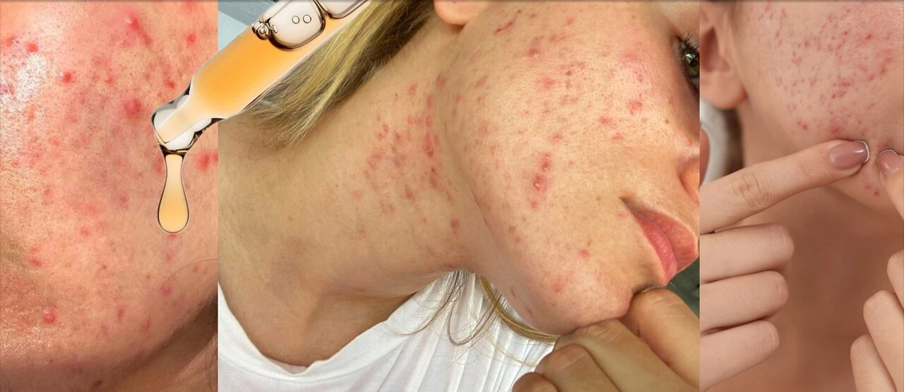 Akné v dospelosti: Prečo sa objavuje, ako ho riešiť a kedy vyhľadať odborníka